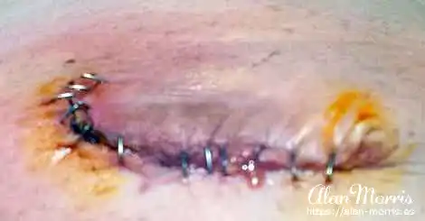 Staples in stomach of Alan Morris