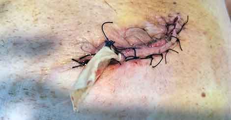 Stitches in belly of Alan Morris