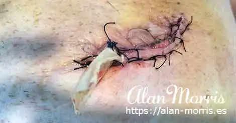 Stitches in belly of Alan Morris